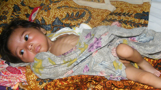 Sistia bayi penderita gizi buruk asal Nusa Tenggara Barat