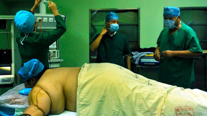 Operasi Sedot Lemak Bagi Penderita Obesitas di Cina