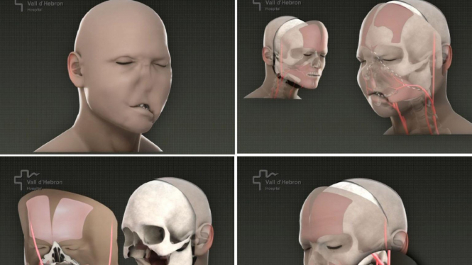 Rekonstruksi operasi total wajah di Spanyol