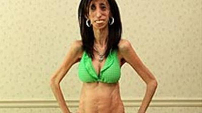 Lizzie Velasquez