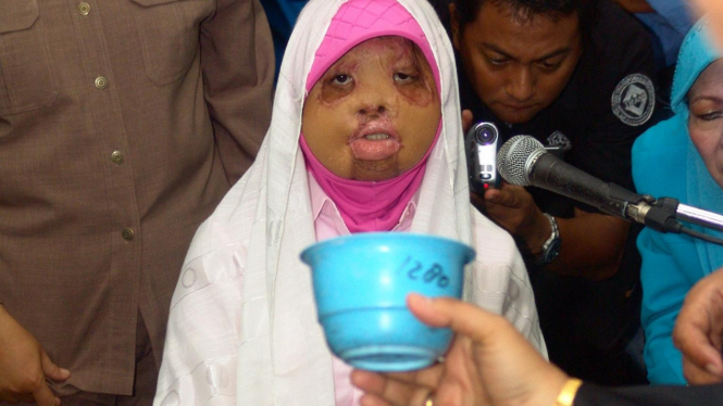 Siti Nur Jazila, Pasien Face-off 