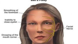 Pernah Dialami Sederet Selebriti Muda, Ahli Ungkap Penyebab Bell's Palsy