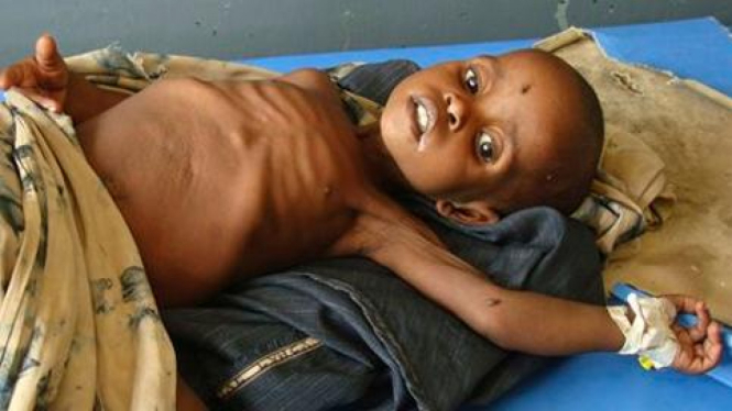 Anak kekurangan gizi di Somalia. 