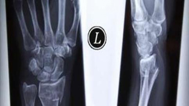 Wrist x-ray