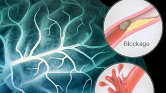 Tiga Kebiasaan Sehat Ini Ampuh Cegah Stroke