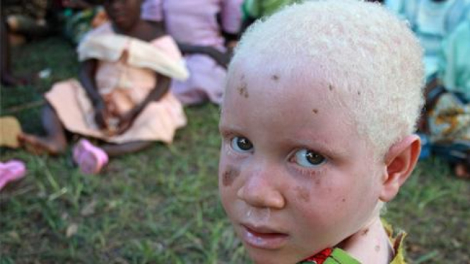 Anak albino di Tanzania