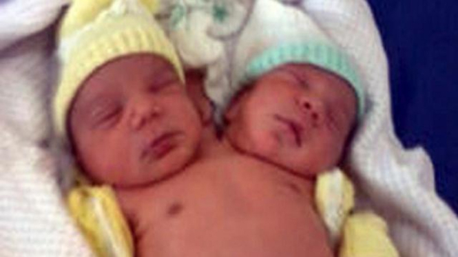 Bayi berkepala dua di Brazil