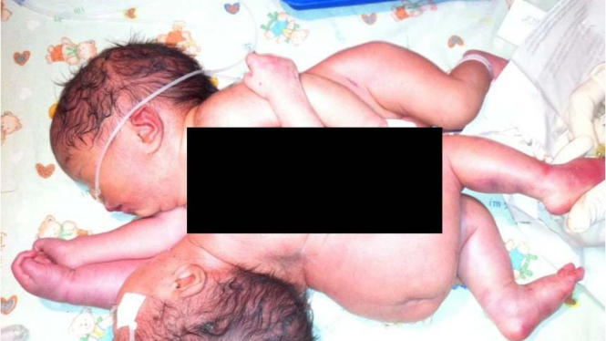 Bayi kembar siam dari pasangan Riswanto dan Parsini di Pekanbaru, Riau