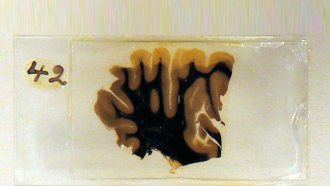 Potongan otak Albert Einstein