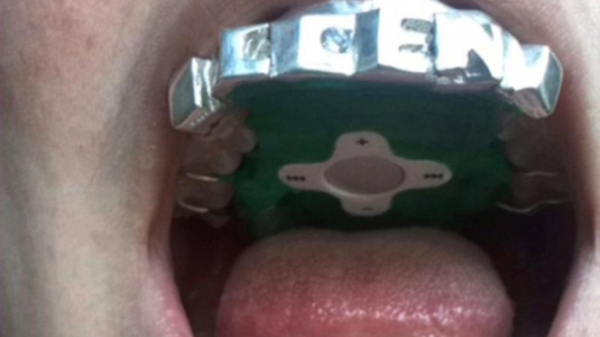 Play-A-Grill, MP3 player yang terpasang di kawat gigi