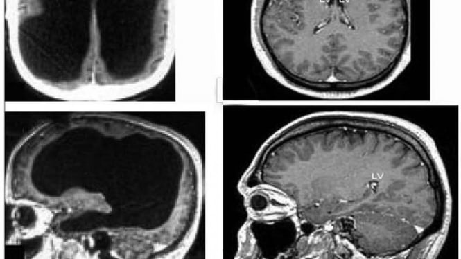 Otak tertutup cairan (kiri), otak normal (kanan)