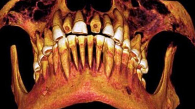 Rekonstruksi gigi mumi Mesir