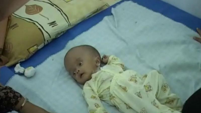 Bayi penderita Hidrosefalus yang ditelantarkan orangtuanya