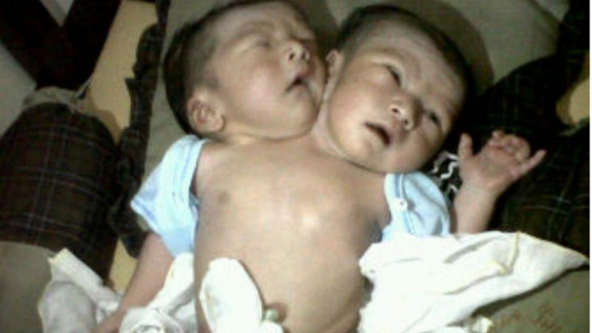 Bayi laki-laki di Cilacap, Jawa Tengah, terlahir dengan dua kepala. (27/06/2013)