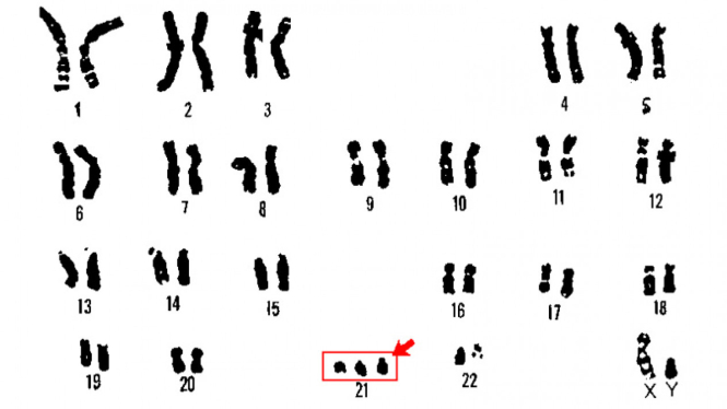 Kromosom down syndrome