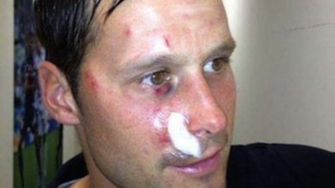 Kiper asal Swiss, David Zibung, mengalami luka di wajah
