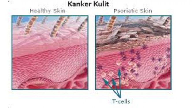 kanker kulit.