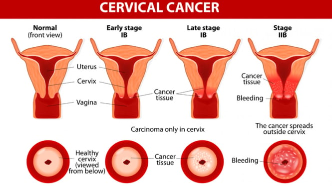 Ilustrasi kanker serviks