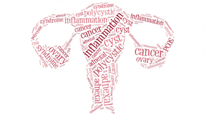 Ilustrasi kanker ovarium
