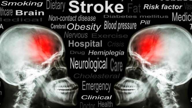 Ilustrasi Stroke