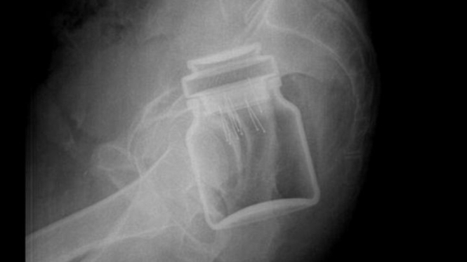 Citra X-ray memperlihatkan benda yang tersangkut di bokong