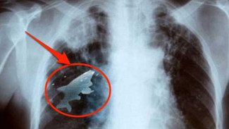 Lima Foto Rontgen yang Menunjukkan Hal Gila di Tubuh Manusia