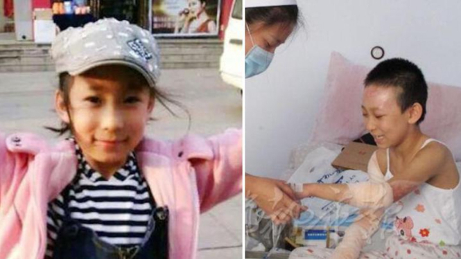 Gadis 9 tahun terluka, berusaha selamatkan neneknya dari kebakaran.