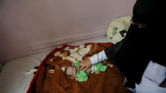 Foto-foto Memilukan Anak-anak Kelaparan di Yaman
