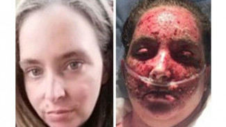 Hilangkan Eksim Pakai Pemutih, Ibu Ini Alami Luka Bakar