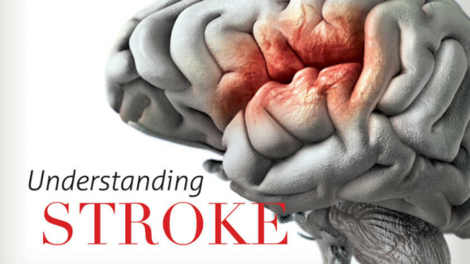 Ilustrasi stroke.