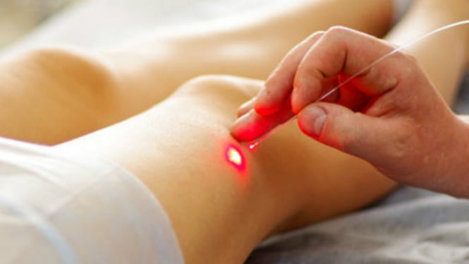 laser nou cu varicoza