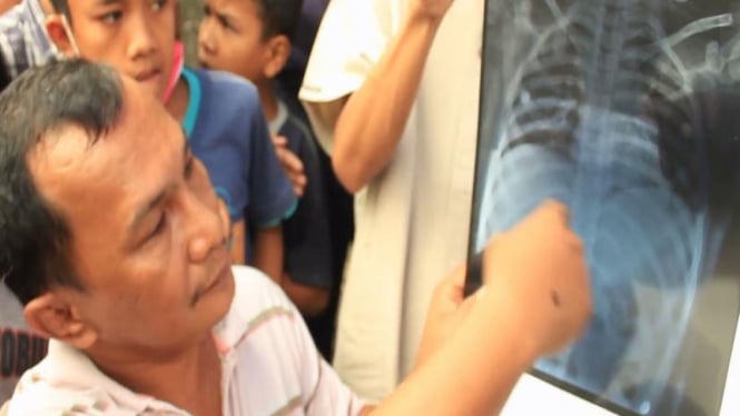 Hasil rontgen paru-paru bocah Riau yang dipenuhi asap