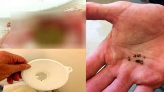 Keluarkan Batu Ginjal dengan Resep Berikut Ini