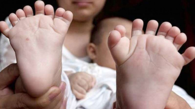 Bayi dengan 16 jari kaki 