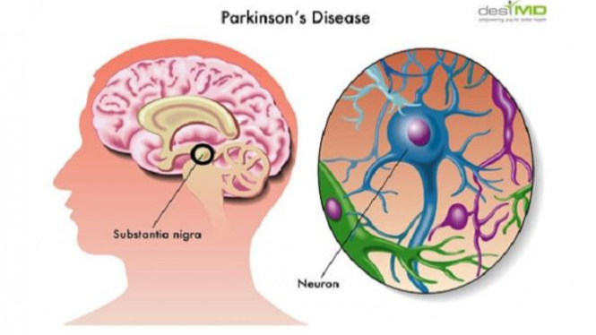 Ilustrasi parkinson.