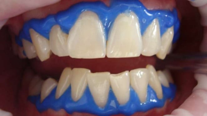 Ilustrasi whitening gigi, gigi, perawatan gigi dan mulut.