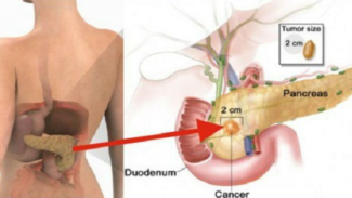 Benarkah Kolesterol Tinggi dan Asam Urat Sebabkan Kanker Pankreas?