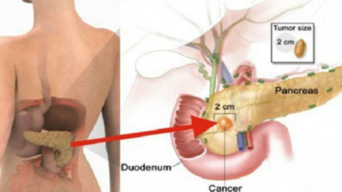 Ilustrasi kanker pankreas.