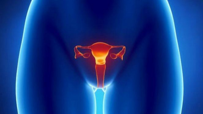 Ilustrasi kanker ovarium.