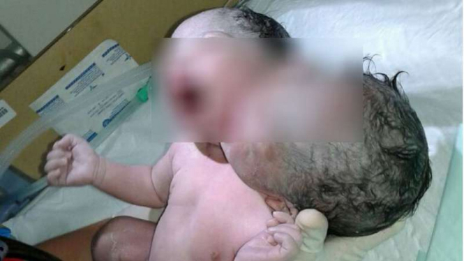 Bayi kembar siam prematur lahir di Rumah Sakit Wahidin Sudirohusodo, Makassar.