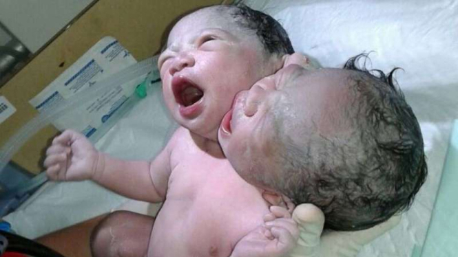 Bayi berkepala dua di Makassar