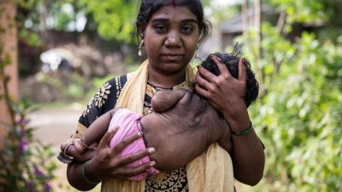 Manisha Sambhaji Raut (22), pengidap sindrom manusia serigala yang melahirkan anak dengan sindrom serupa.