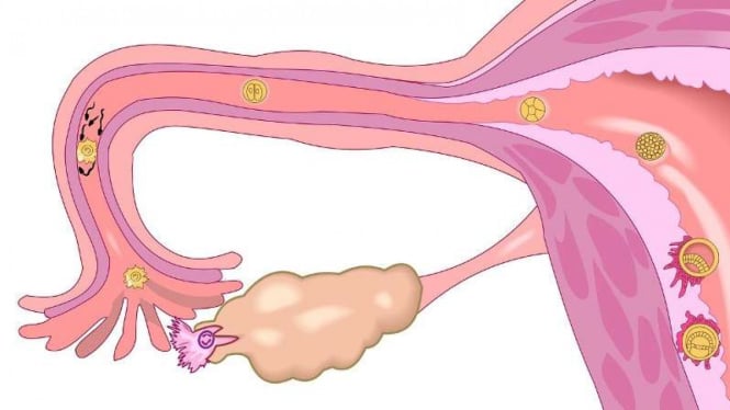 Ilustrasi pembuahan sel telur dalam rahim