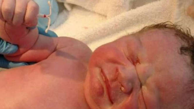 Bayi Dexter lahir dengan menggenggam alat kontrasepsi sang ibu
