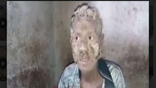 Suyanto, warga Pulau Buru Maluku yang diduga mengidap penyakit langka. Seluruh kulit kepalanya mengelupas dan menjadi seperti lempengan kayu.