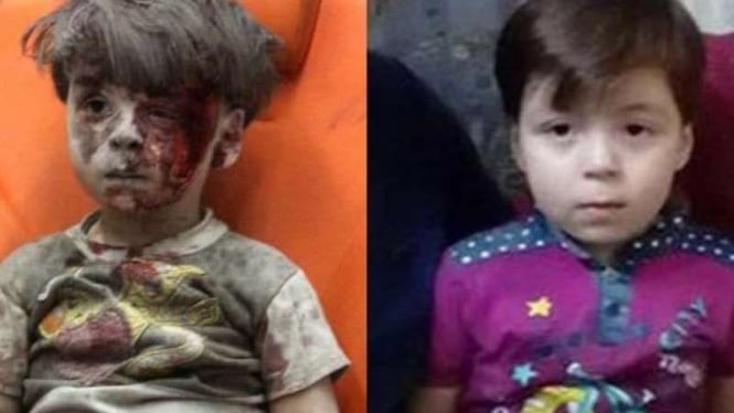 Omran Daqnessh, bocah Suriah saat terluka akibat bom dan kondisi terkininya.