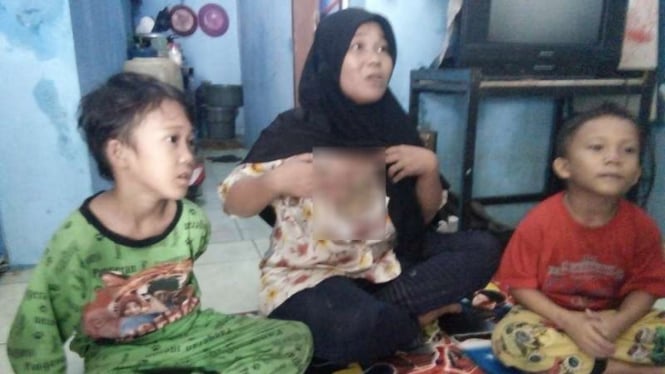  Neneng Safitri (33) menunjukkan luka membusuk akibat kanker payudara yang dideritanya sejak setahun lalu. Karena tak memiliki uang ia hanya bisa menahan sakit, Kamis (3/8/2017)