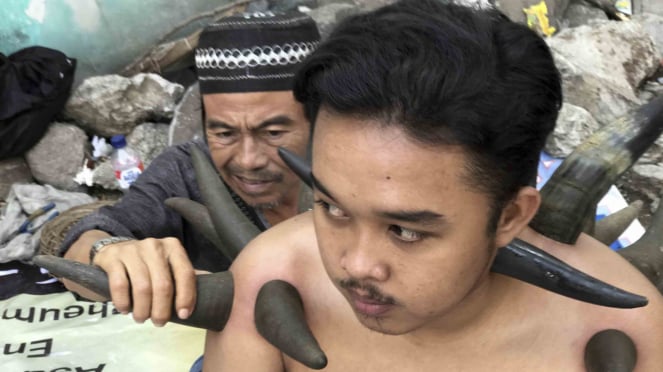 Pengobatan Bekam Tanduk Kerbau di Jakarta