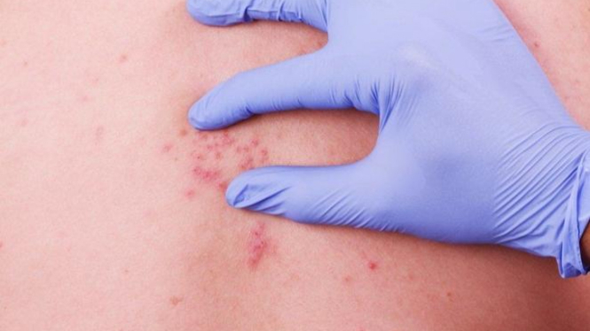 Stress during the COVID-19 Pandemic Triggers Shingles, How Can?