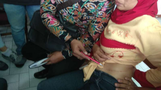 Sisa bekas operasi ginjal yang tersisa di tubuh Ita Diana, warga Kota Malang yang kini tertipu, Kamis (21/12/2017)